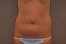 Tummy Liposuction