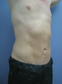 Tummy Liposuction