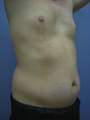 Tummy Liposuction