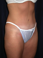 Tummy Liposuction