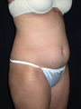 Tummy Liposuction
