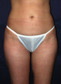 Tummy Liposuction