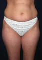 Tummy Liposuction