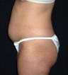 Tummy Liposuction