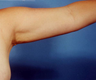 Arm Lift
