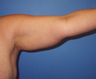 Arm Lift