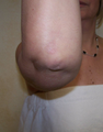 Arm Lift