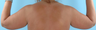 Arm Lift