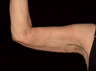 Arm Lift