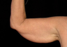 Arm Lift