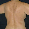 Back Lift
