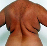 Back Lift