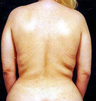 Back Lift