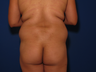 Back Lift