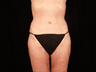 Lift of Thighs, Hips, and Butt