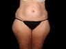 Lift of Thighs, Hips, and Butt