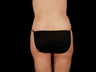 Lift of Thighs, Hips, and Butt