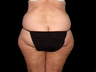 Lift of Thighs, Hips, and Butt