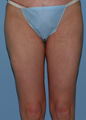 Thigh Lift