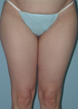 Thigh Lift