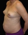 Breast Augmentation and Tummy Liposuction