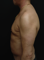 Tummy Liposuction