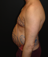 Tummy Liposuction