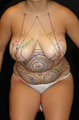 Breast Lift and Tummy Liposuction
