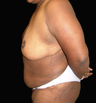 Tummy Liposuction