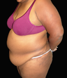 Tummy Liposuction