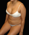 Tummy Liposuction