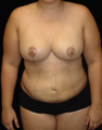 Breast Reduction/Lift and Tummy Liposuction