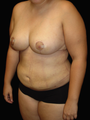 Breast Reduction/Lift and Tummy Liposuction