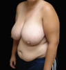 Breast Reduction/Lift and Tummy Liposuction