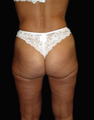 Hip Liposuction