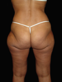 Hip Liposuction