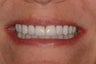 Smile Makeover