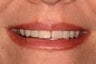 Smile Makeover