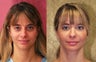 facial fat grafting