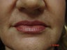 Fraxel repair