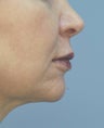 Lip Augmentation with Juvederm