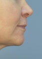 Lip Augmentation with Juvederm