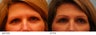 Eyebrow Hair Transplant