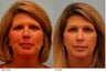 Eyebrow Hair Transplant