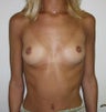 bilateral Breast Enlargement