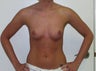 breast enlargement