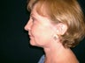 Necklift