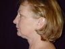 Necklift