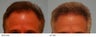 Hair Transplant