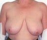 Breast Reduction